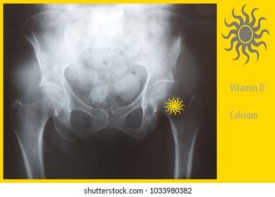 Prevention Osteoporosis Hip Fracture Concept Xray Stock Photo ...