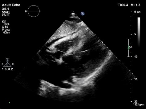 EE 020 Echo 1 subcostal - INTENSIVE