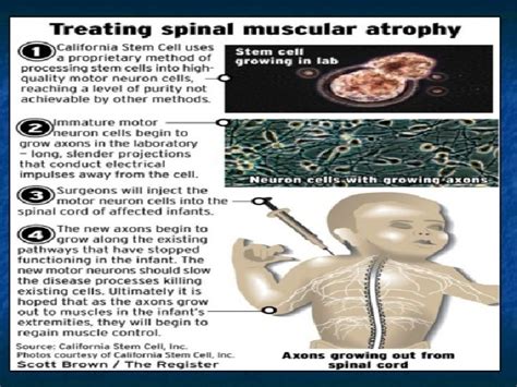 Motor Neuron diseases Classification Lower motor neurons disorders