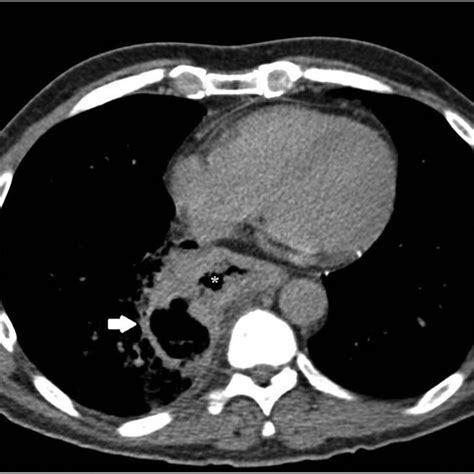 Axial section of computed tomography showing the epiphrenic... | Download Scientific Diagram