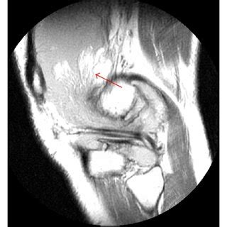 MRI of a 22-year-old male patient with lipoma arborescens of knee... | Download Scientific Diagram