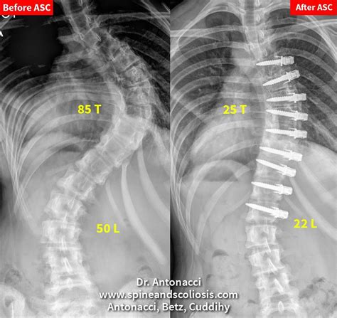 SA 14 Scoliosis Single Severe Curve from 85 Thoracic - Institute for ...