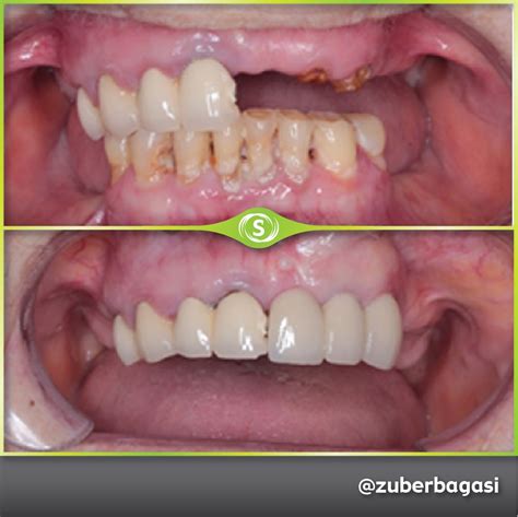 3 Unit Dental Implant Bridge - Dr. Zuber Bagasi • Synergy Dental Clinic