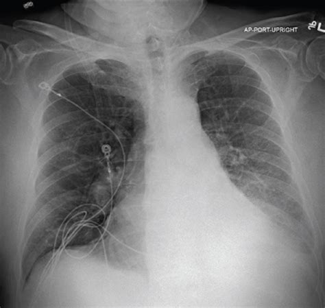 Clinical Spotlight Zephyr Valve Treatment Results - Pulmonx