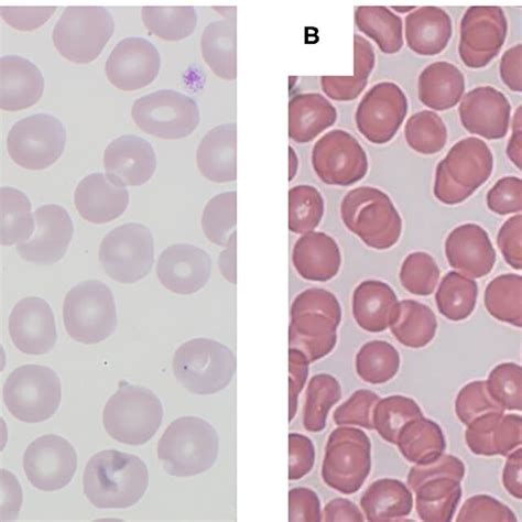 Peripheral blood smears (magnification × 1000): (A) Case 1 illustrating ...