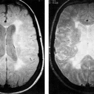 (A) Diffuse periventricular white matter lesions are seen outlining the... | Download Scientific ...