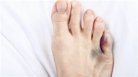 Sprained Toe: Diagnosis and Treamtment by a Foot Specialist