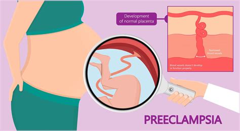 Complications during Pregnancy