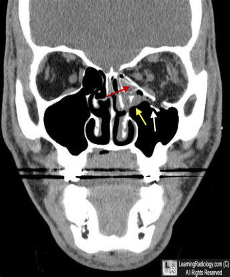 Blowout Fracture