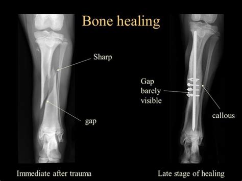 Radiology of bone healing Flashcards | Quizlet