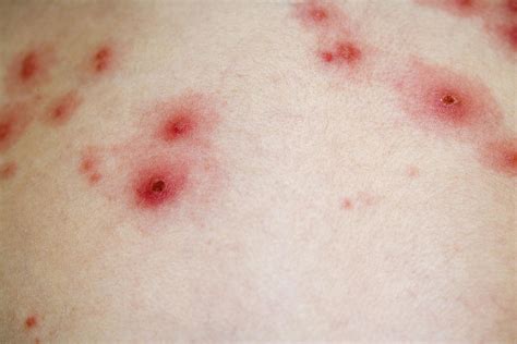 Chickenpox Rash Photograph by Science Stock Photography - Fine Art America