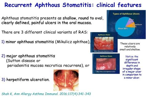 Recurrent aphthous stomatitis