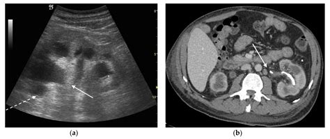 Pyonephrosis Ultrasound