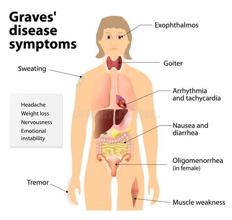 Graves' Disease Or Basedow Disease. Symptoms And Signs Stock Vector ...