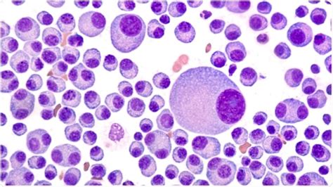 Multiple Myeloma What To Expect