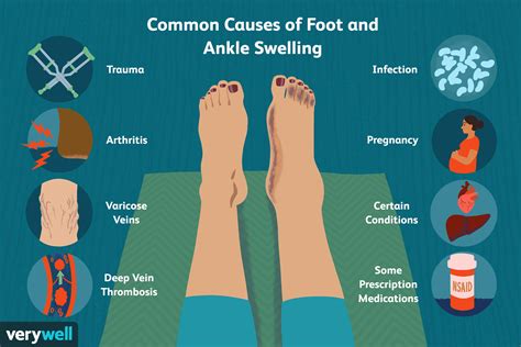 Common Causes of Foot and Ankle Swelling