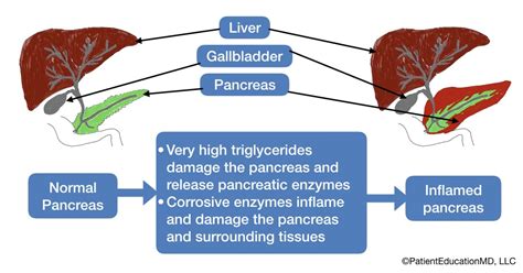 Pancreatitis from high triglycerides - PatientEducationMD