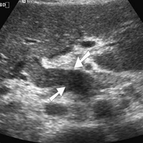 Ultrasound of Cholangitis - Radiology Imaging