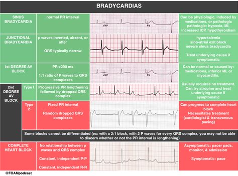 Sinus Bradycardia