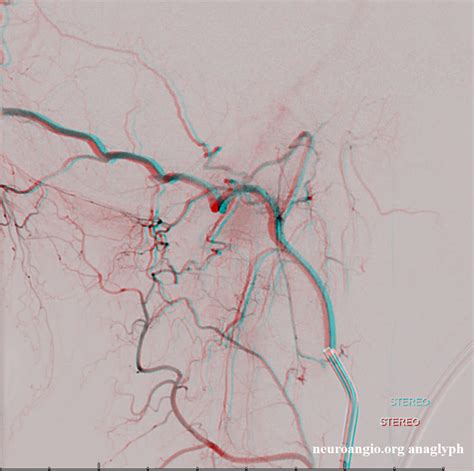 Ascending Pharyngeal Artery | neuroangio.org