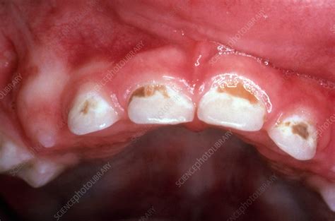 Baby Bottle Tooth Decay - Stock Image - C030/5528 - Science Photo Library