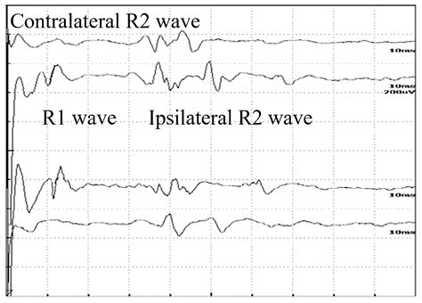 Blink Reflex Examination in Patients with Amyotrophic Lateral Sclerosis ...