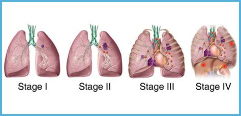 Lung Cancer Staging | St. Stamford Modern Cancer Hospital Guangzhou