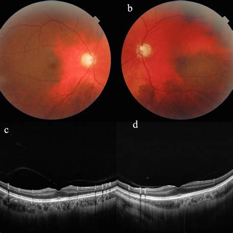 PS-OCT shows diffuse loss of the retinal nerve fiber layer (a). Visual... | Download Scientific ...