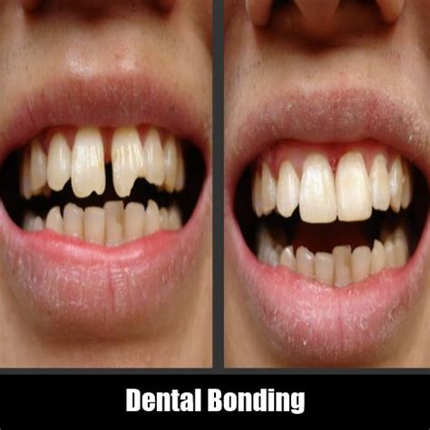 Dental Bonding Know what is dental bonding and what are the advantages and disadvantages of ...