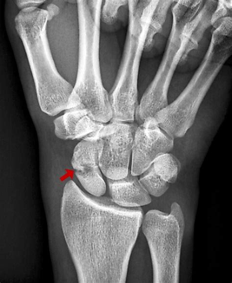 Scaphoid (Navicular) Fractures - Injuries; Poisoning - MSD Manual ...