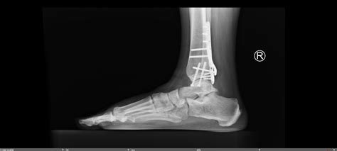 Trimalleolar Ankle Fracture — Chicago Foot & Ankle Orthopaedic Surgeons