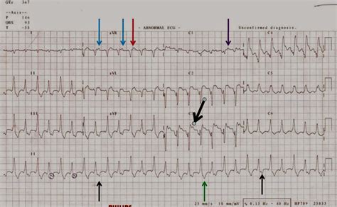 Dr. Smith's ECG Blog: Chest pain, SOB, and tachycardia. What is the rhythm? Is it MI?