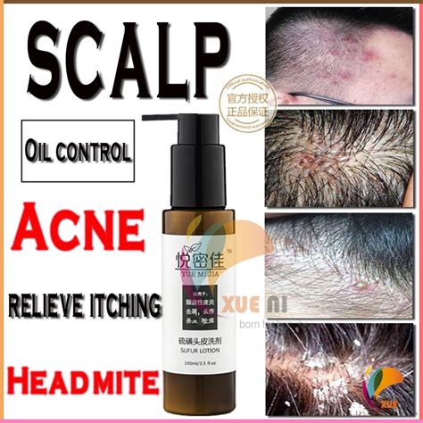 正品止痒去屑洗发水 Scalp folliculitis Red and swollen acne Anti-dandruff and antiitchy Mite shampoo ...