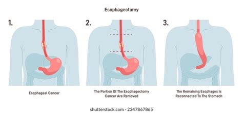 39 Esofagectomia Images, Stock Photos, 3D objects, & Vectors | Shutterstock