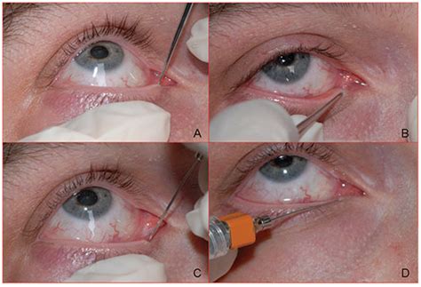 A Practical Approach to Canalicular Lacerations