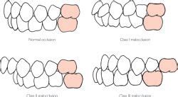 Malocclusion, Angle Class Ii; Angle Class II