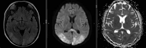 Cureus | Predictors of Posterior Reversible Encephalopathy Syndrome (PRES) in Women With Pre ...