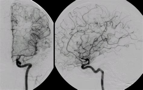 Internal Carotid