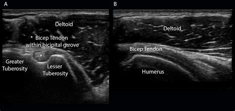 Riprodurre televisore mille rotator cuff tear ultrasound Abituale vedere Charlotte Bronte