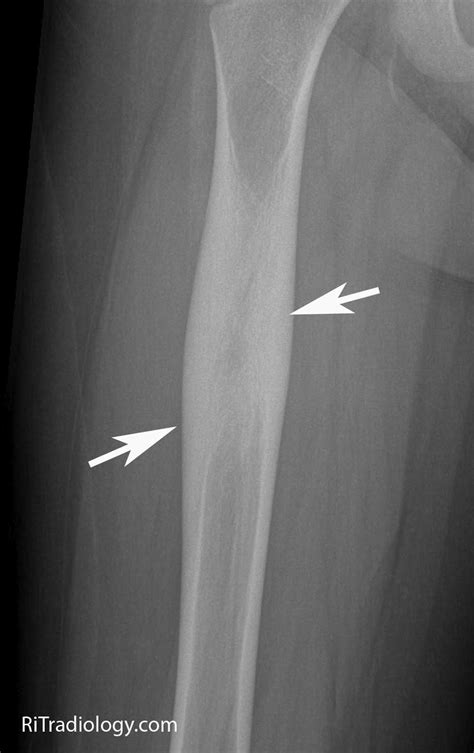 RiT radiology: Osteoid Osteoma