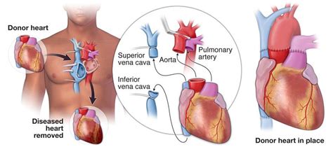 Heart Transplant | Temple Health