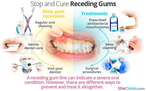 Stop and Cure Reciding Gums | Gum treatment, Receding gums, Gum ...