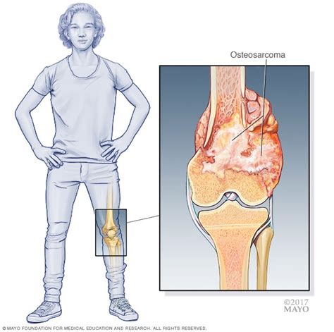 Symptoms and causes - Bone cancer - Mayo Clinic