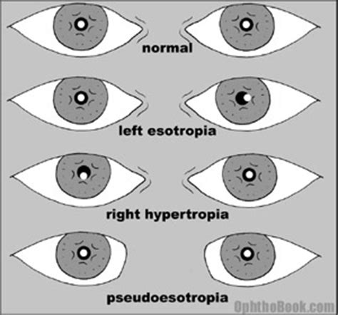 What's the Hirschberg test? - TimRoot.com