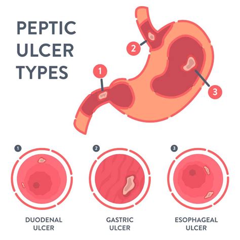 Peptic Ulcers - Symptoms & Causes | Gleneagles Hospital