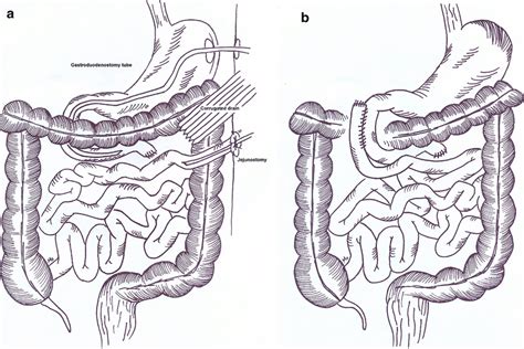 The jejunal anastomosis was took down and corrugated drain, gastrostomy ...