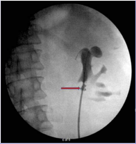 Retrograde pyelogram in 2016, during stent exchange. The guidewire is ...