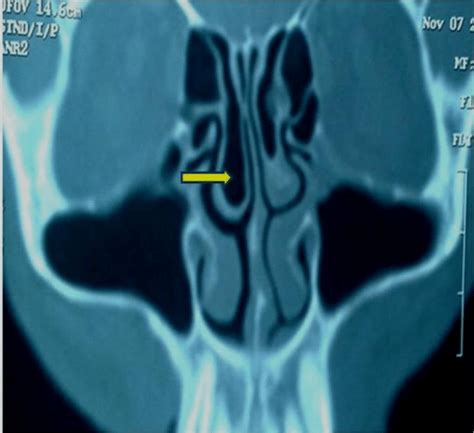 CT scan of nose and paranasal sinuses of right-side middle turbinate... | Download Scientific ...