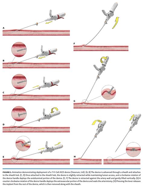 A Single-Center, Single-Operator Experience With the Celt ACD Vascular ...