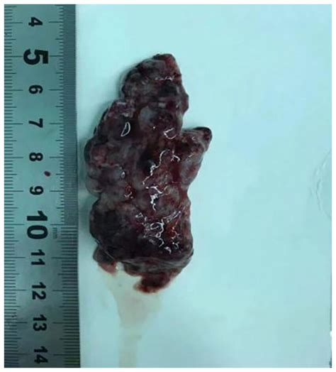 Gross visual observation of the surgically excised cervical spinal cord... | Download Scientific ...